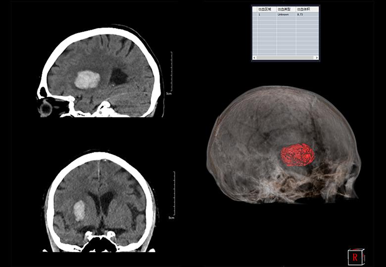 Cerebral hemorrhage analysis