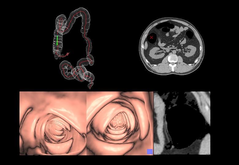 Colon analysis