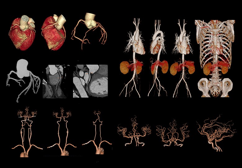 Coronary Scan