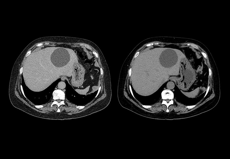 Abdomen Scan