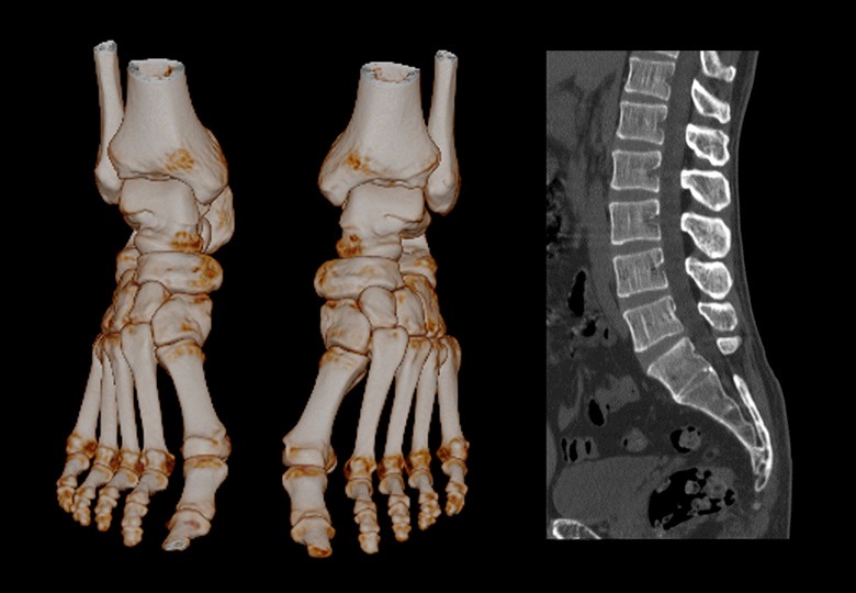 Bone Scan