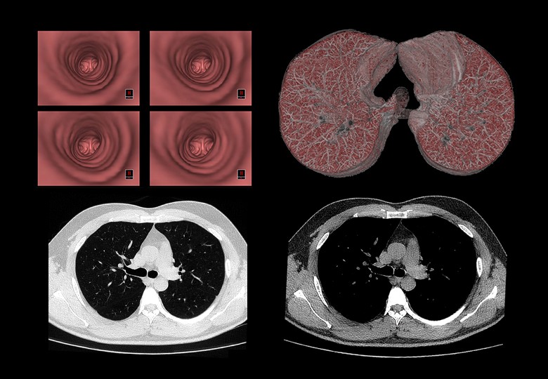 Lung Scan