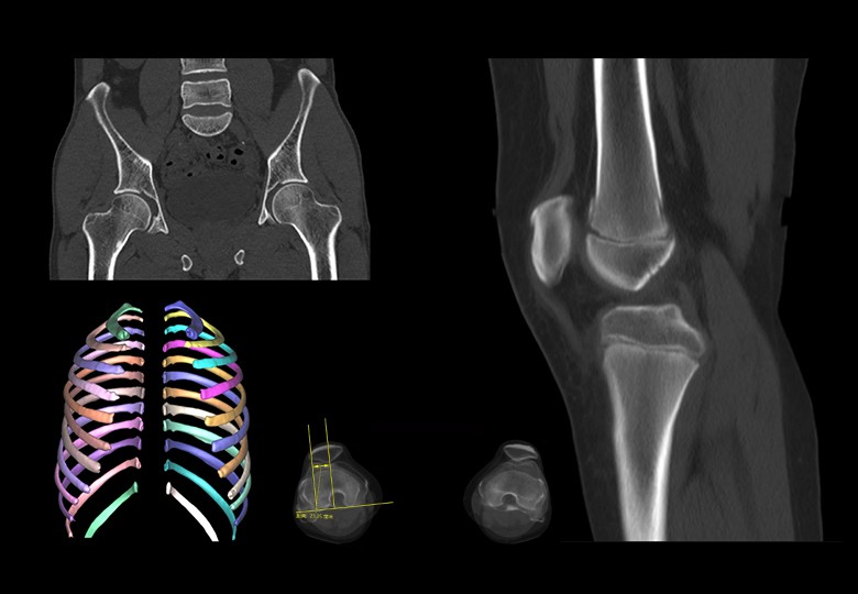 Bone Scan